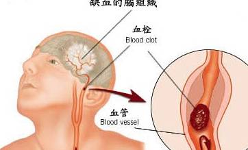 身体出现5种表现,十有八九是脑血管堵了,尽早去查一下脑CT