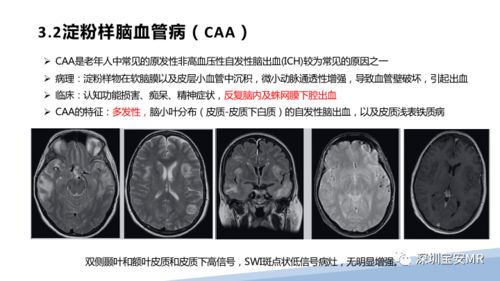 精品推荐 swi在中枢神经血管病变中的应用